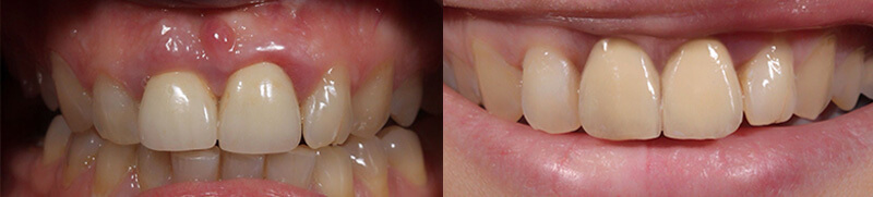 Alargamiento de corona dental