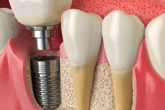 implantes dentales cuando no hay hueso suficiente