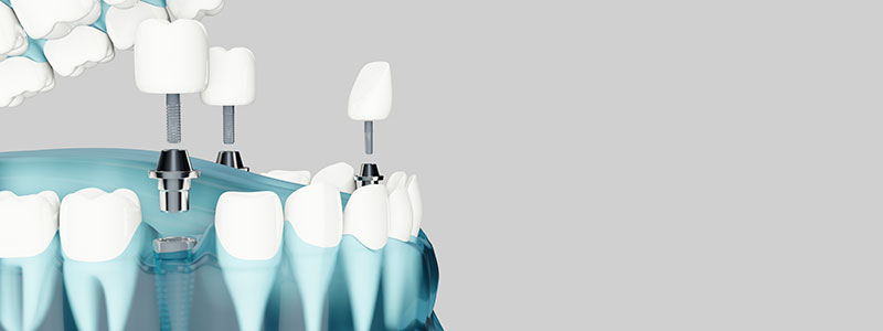 Injero de hueso dental - Implantes dentales