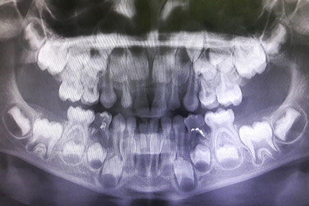 Radiografía dental panorámica