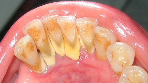 Sarro dental 