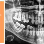 ¿Qué se ve en una radiografía dental?