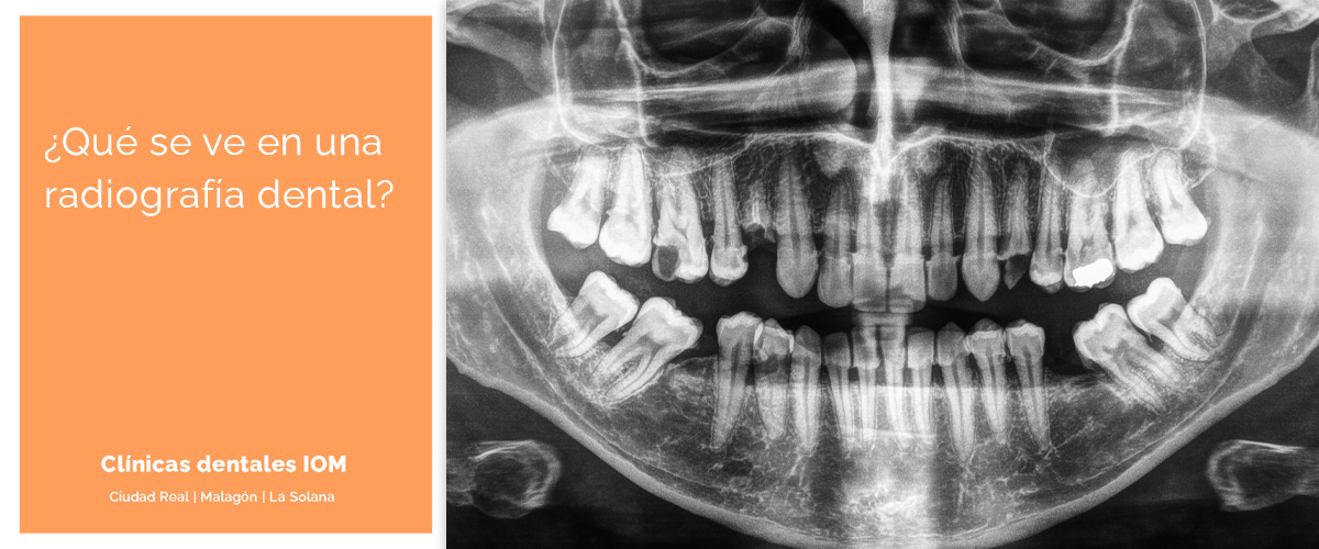 En este momento estás viendo ¿Qué se ve en una radiografía dental?