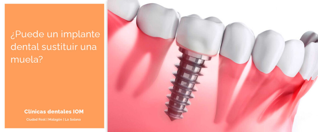 puede un implante dental sustituir una muela