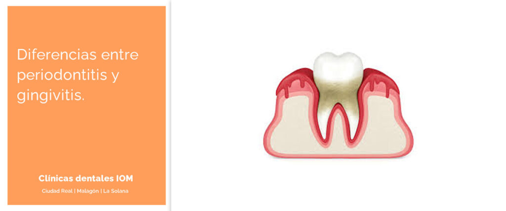 periodontitis y gingivitis