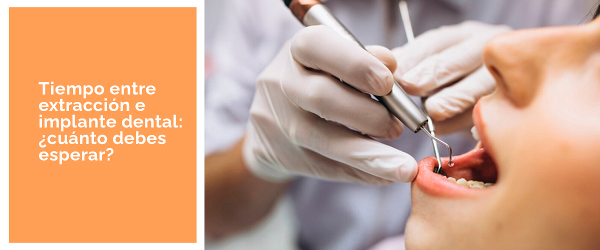 Implantes Dentales Post-extracción