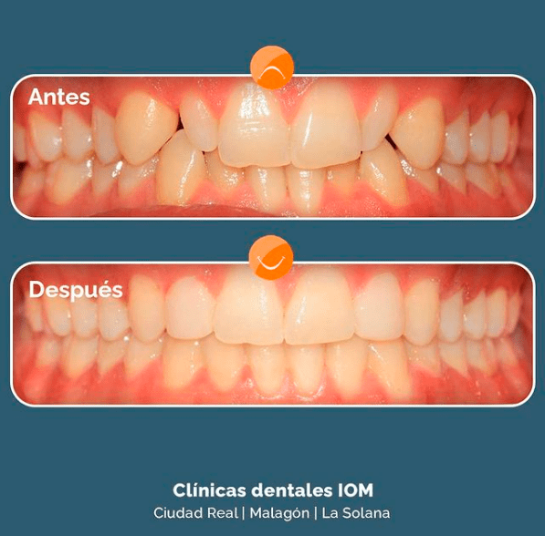 iom - ortodoncia-invisible-invisaling-antes-y-despues