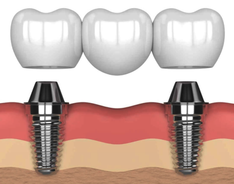 puente dental sobre implante