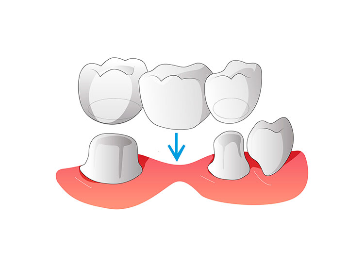 Puente dental fijo tradicional