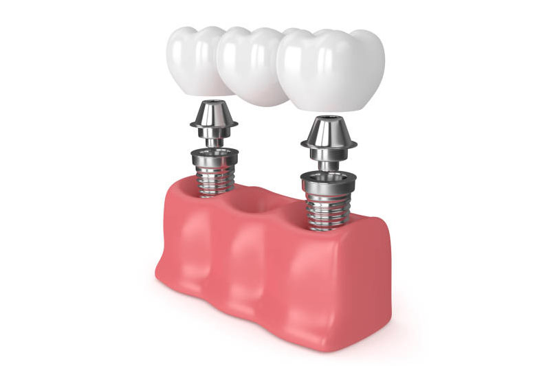 puente dental fijo sobre implantes