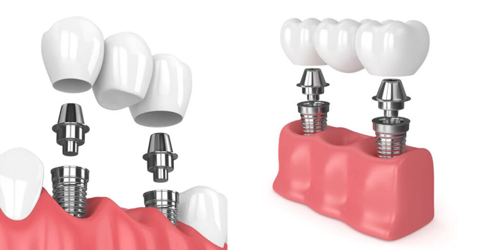 puente dental fijo sobre implantes