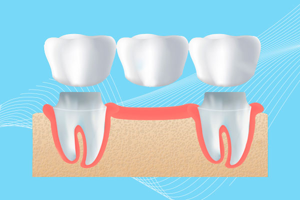 puente dental fijo