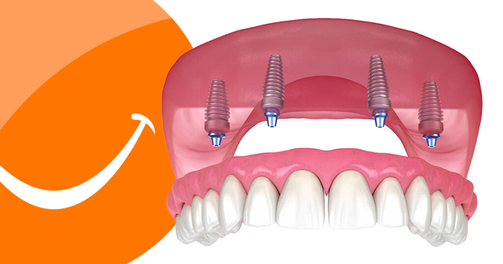 sobredentadura sobre 4 implantes superior