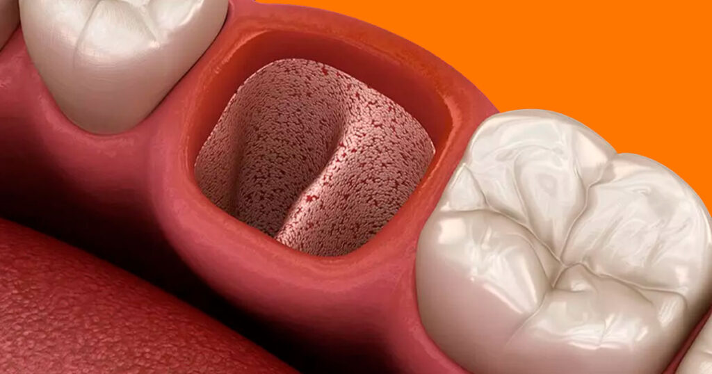 alveolitis seca