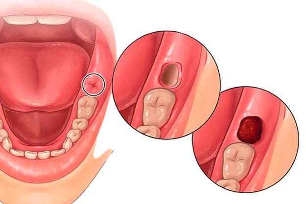 alveolitis seca