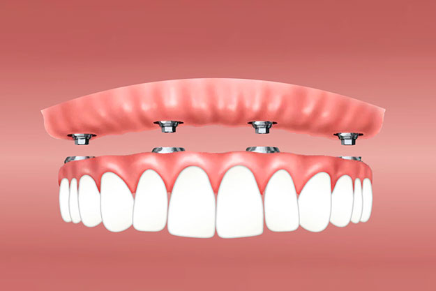 sobredentadura sobre 4 implantes superior